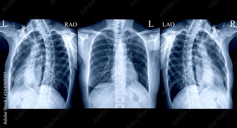 collection Chest X-ray or X-Ray Image Of Human AP and both oblique view for detect fracture Rib ...