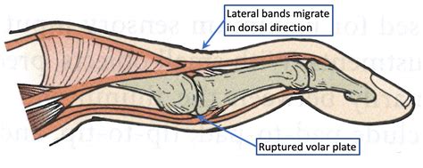 Swan Neck deformity