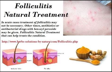 Folliculitis Staph Infection Treatment