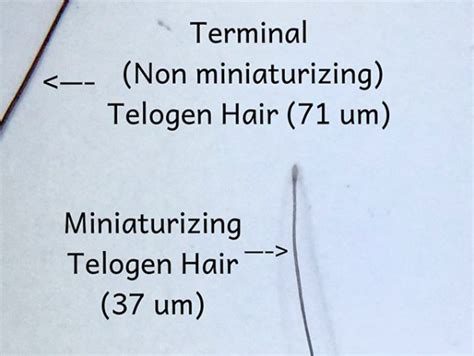 Telogen Hairs: Terminal, Miniaturizing and Vellus — Donovan Hair Clinic