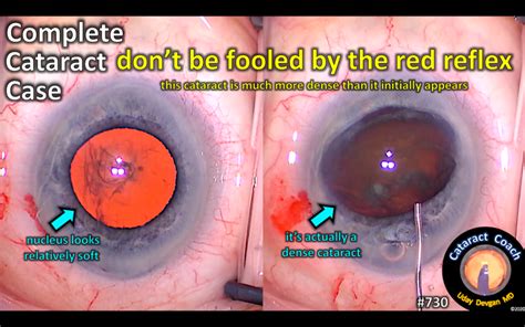 complete cataract case: great red reflex – Cataract Coach