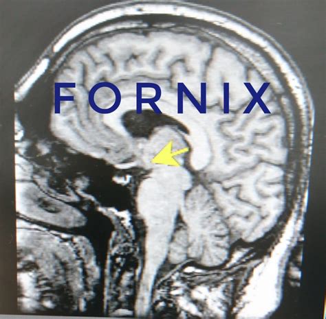 MRI / PET FORNIX – Blog de Fisioterapia