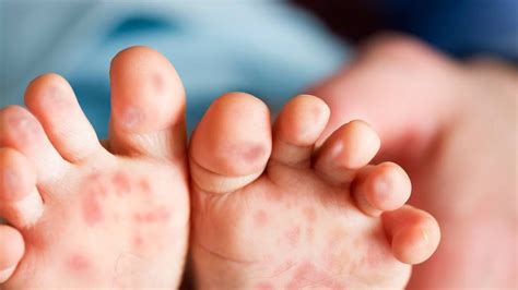 Protecting Loved Ones from Hand, Foot and Mouth Disease | GetDoc Says