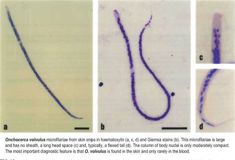 Figure 13 from Filariasis: diagnosis and treatment. | Semantic Scholar