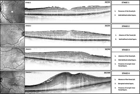 New Retinal Physician | PentaVision