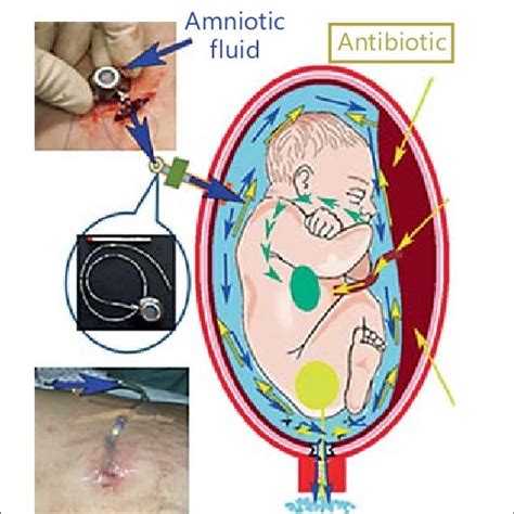 Histologic examination of the chorioamniotic membranes after PPROM... | Download Scientific Diagram