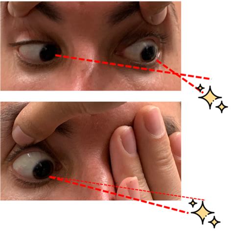 The OD's Practical Approach to Double Vision | CovalentCareers