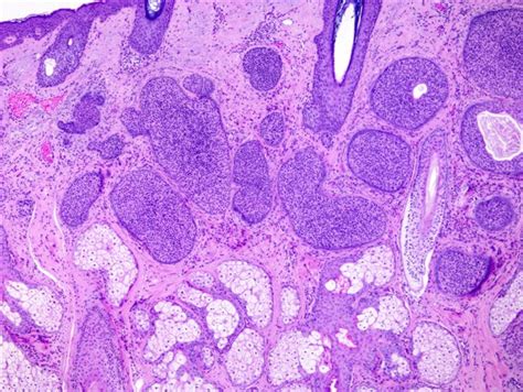 Pathology Outlines - Trichoepithelioma / trichoblastoma