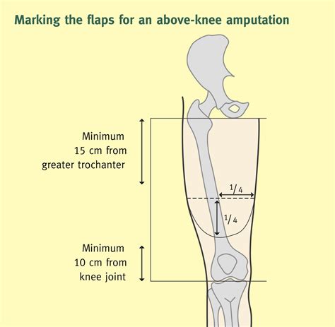 Amputation and rehabilitation - Surgery - Oxford International Edition