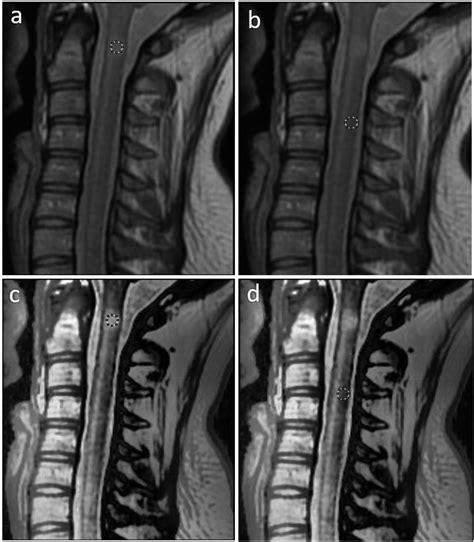 Cervical Spine Mri Comparison