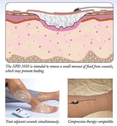 Negative-pressure wound therapy