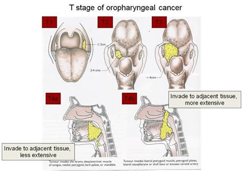 Dentistry lectures for MFDS/MJDF/NBDE/ORE: TNM Staging Of Oropharyngeal Cancer