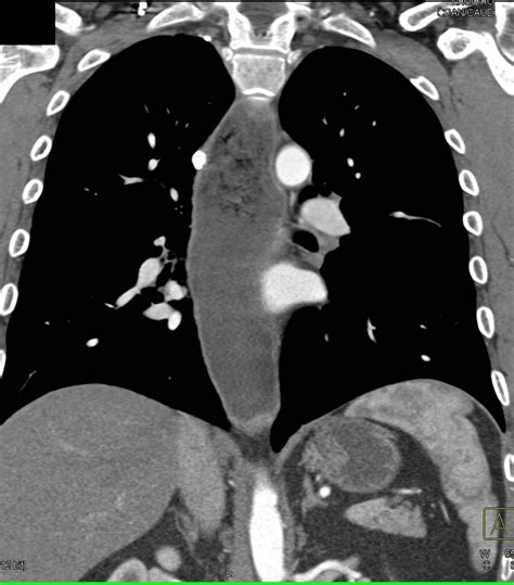 Achalasia with Dilated Esophagus - Esophagus Case Studies - CTisus CT Scanning