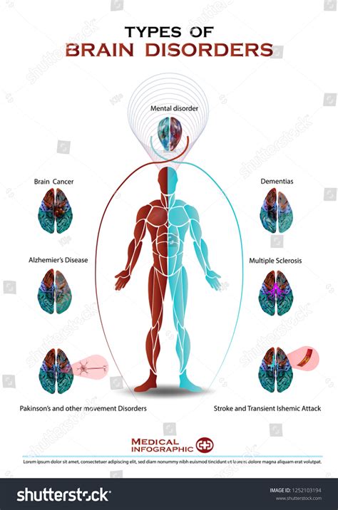 Type Human Brain Disorder Infographic 库存矢量图（免版税）1252103194 | Shutterstock