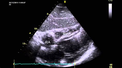 Subcostal 4 chamber view of a normal heart - YouTube