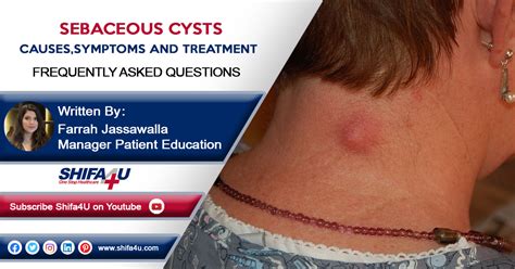 Sebaceous Cysts Symptoms Causes And Treatment Skinkraft | Images and Photos finder