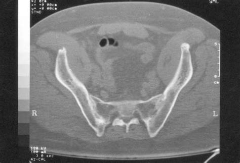 Sacroiliac CT of our patient, demonstrating bilateral sacroiliitis. | Download Scientific Diagram