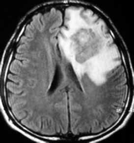 There was severe peritumoral edema in flair scans. | Download Scientific Diagram