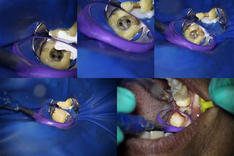 Perforation management – TDO University