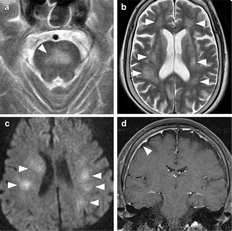 Categorization of abnormal brain MRI imaging in patients with IVLBCL. a... | Download Scientific ...