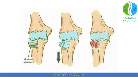 Nursemaid Elbow Reduction | OrthoFixar 2024