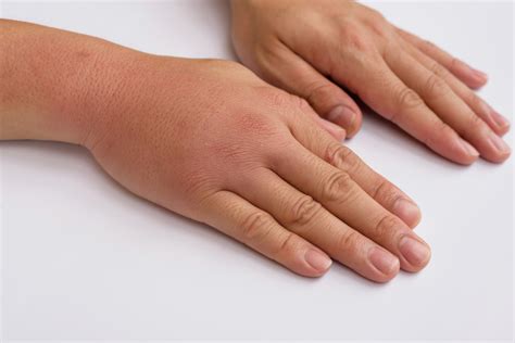 Dealing with a Swollen Hand After a Car Accident - The Accident Doctors