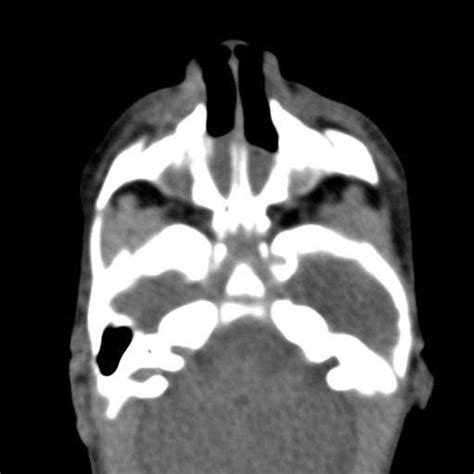 Choanal Atresia - NeuroRad911 Choanal Atresia