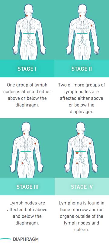 Non-Hodgkin's lymphoma (NHL) stages chart | Non-hodgkin’s lymphoma, Hodgkin’s lymphoma, Non hodgkin