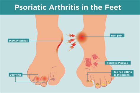 Psoriatic Arthritis in the Feet: Symptoms, Treatment, Home Remedies