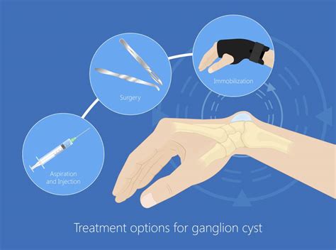 Ganglion Cyst Wrist Treatment Home