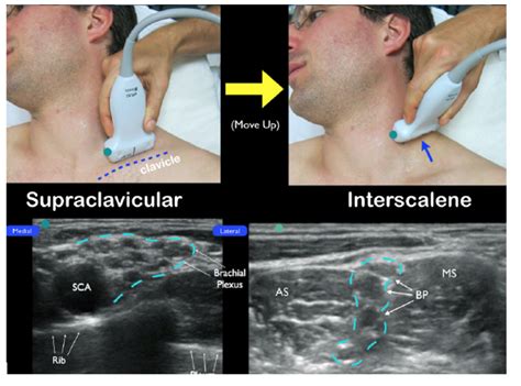 Ultrasound-Guided Interscalene Brachial Plexus Nerve Block – Core EM