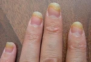 Fingernail Fungus - Causes, Picture, Symptoms and Treatment