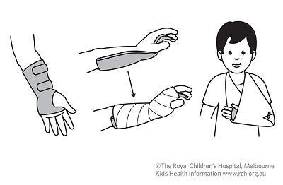 Kids Health Info : Fracture care: buckle injury