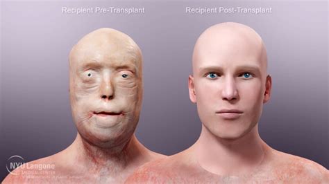 Medical Animation Details Face Transplant Surgery at NYU