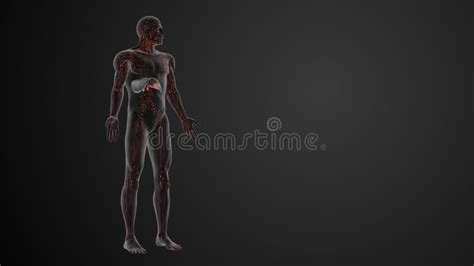 Prognosis and Staging of Lymphoma Stock Image - Image of illness, tumor ...