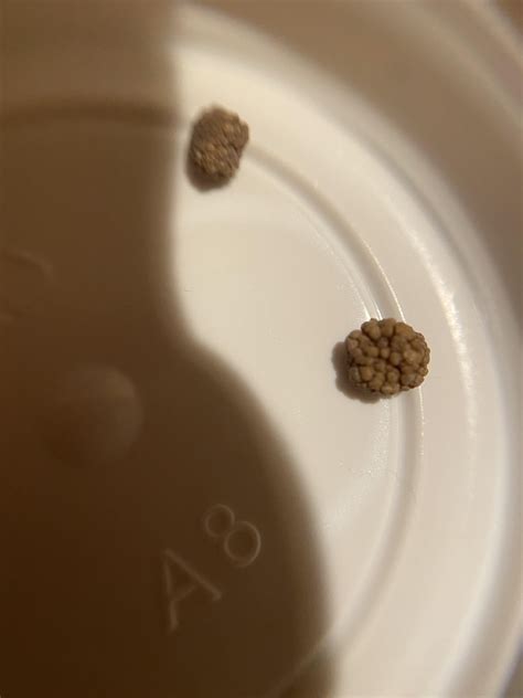 7mm kidney stone surgically removed, also had a 5mm taken out too. : r/KidneyStones