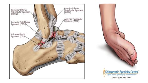 Treatment for Foot Pain and Chronic ankle instability