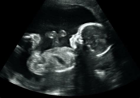 Downs Syndrome and Anomaly Scans - Ultrasound Services