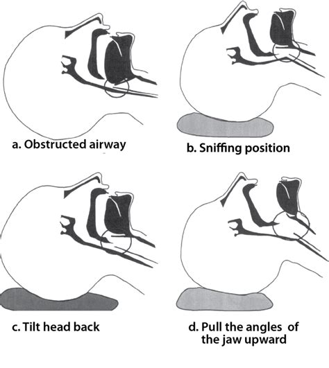 Airway Emergency: Start With The Basics of Airway Management - The Airway Jedi