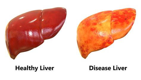 Know the Essential Facts about Your Liver