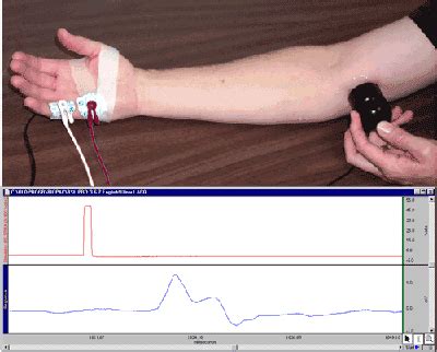 Nerve Conduction Velocity