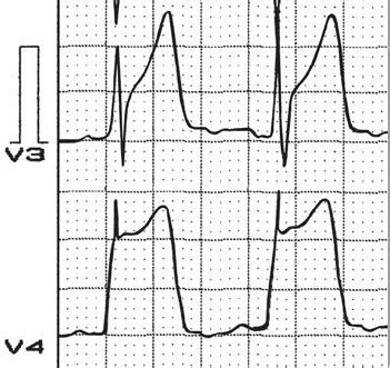 Prinzmetal’s Angina | Cardiac Health