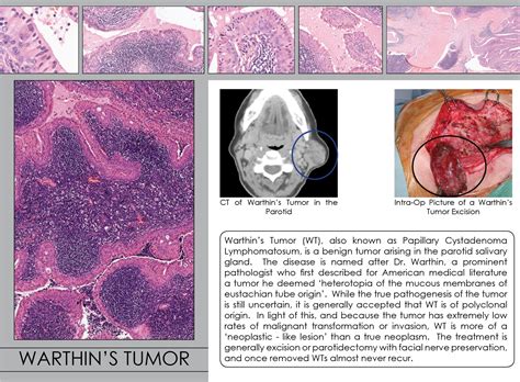 Tumor De Warthin