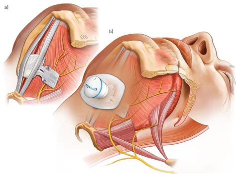 Bilateral hypoglossal nerve stimulation for treatment of adult ...