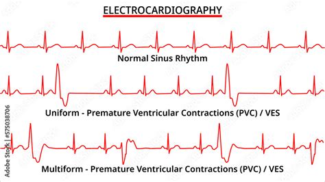 Set of ECG Common Abnormalities - Normal Sinus Rhythm - Uniform and ...