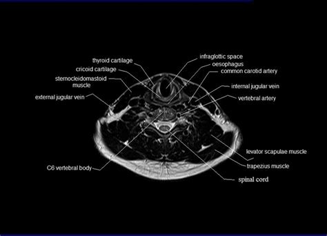 MRI neck anatomy | free MRI axial neck cross sectional anatomy | Mri ...