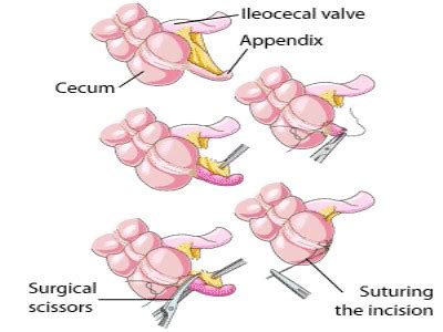 AO-MEDICINE: Appendicectomy : Types, Indications, Steps, Postoperative ...