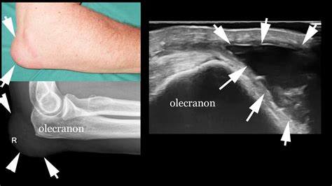 Common extensor tendon tear - The Ultrasound Site