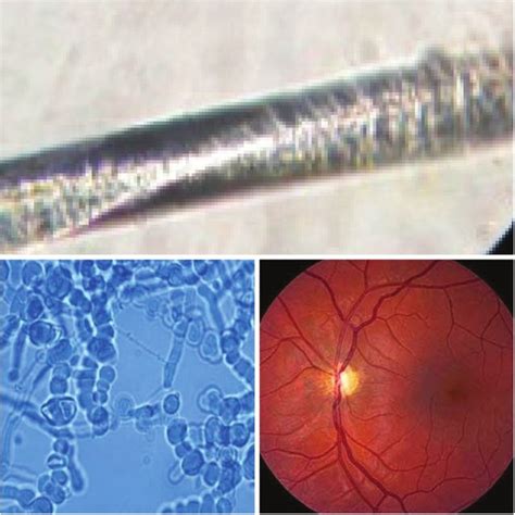 Pili torti, LPCB preparation showing, and rat tail macroconidia,... | Download Scientific Diagram