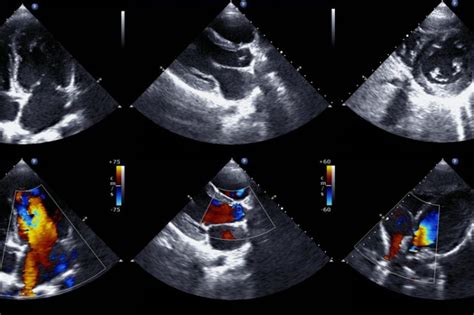 What to Expect during an Echocardiogram | UPMC HealthBeat